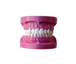 Cast without articulator